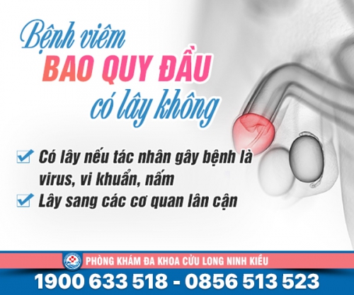 Tò mò: Bệnh viêm bao quy đầu có lây không