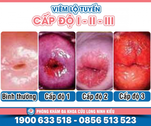Nhận biết sớm các cấp độ của viêm lộ tuyến cổ tử cung