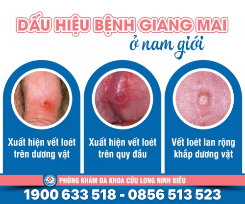 Nhận biết: Biểu hiện của bệnh giang mai