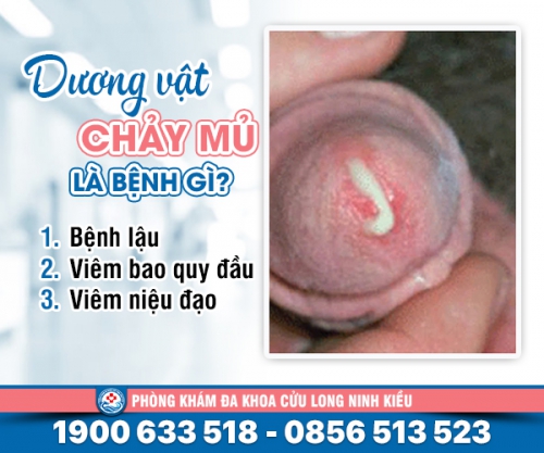 Lắng nghe chia sẻ: Dương vật chảy mủ là bệnh gì