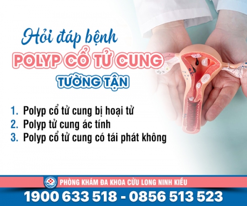 Hỏi đáp bệnh polyp cổ tử cung tường tận