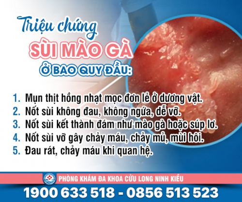 Bệnh sùi mào gà ở bao quy đầu là gì: Nguyên nhân, dấu hiệu và cách điều trị