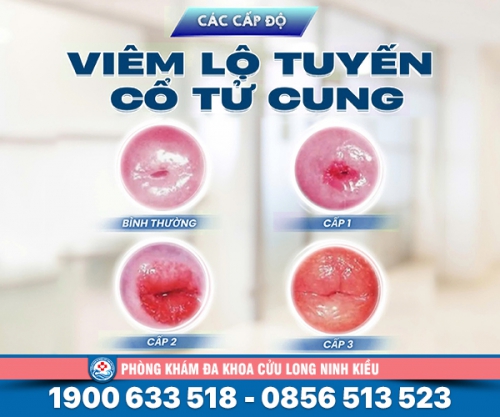 Hình ảnh viêm cổ tử cung lộ tuyến ở nữ giới