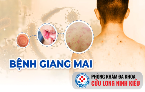 Những thông tin cần biết về bệnh giang mai - Đọc ngay bài viết này
