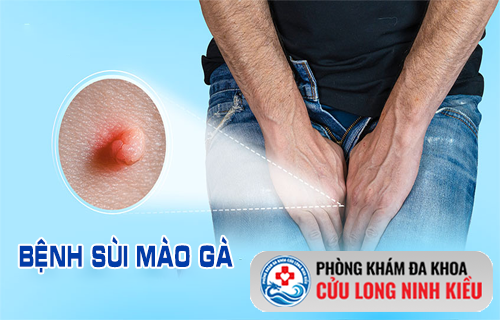 Tổng hợp kiến thức về sùi mào gà cho nam và nữ - Đừng vội bỏ qua