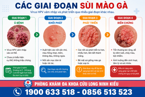 Bệnh sùi mào gà giai đoạn 2: Dấu hiệu nhận biết và mức độ nguy hiểm