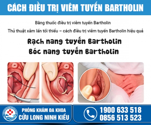 Điều trị viêm tuyến bartholin như thế nào? Ở đâu tốt?