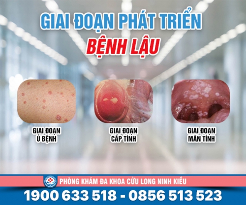 Tìm hiểu : các giai đoạn của bệnh lậu