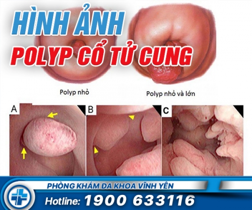 Hình ảnh bệnh polyp cổ tử cung ở nữ giới