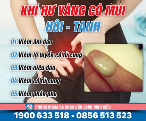 Khí hư vàng có mùi hôi, tanh là bị làm sao? Tìm hiểu ngay