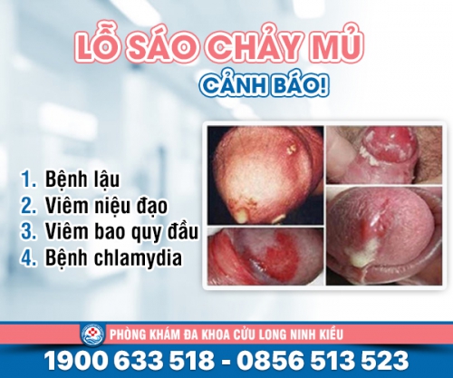 Chảy mủ lỗ sáo: Nguyên nhân và cách khắc phục