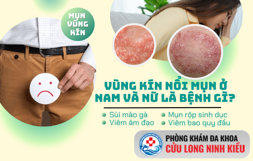 Review các phương pháp loại bỏ mụn vùng kín hiệu quả, an toàn, ít biến chứng