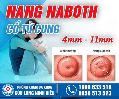 Nang naboth cổ tử cung kích thước 4mm -11mm có đáng lo