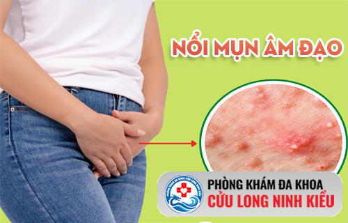 Top những nguyên nhân gây mụn âm đạo phổ biến hiện nay