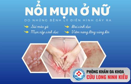Đừng xem hình đoán bệnh: Hiện tượng nổi mụn ở nữ nguy hiểm hơn bạn nghĩ