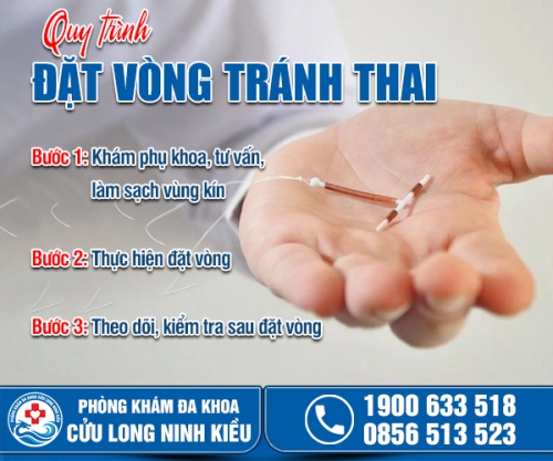 Cách đặt vòng tránh thai: Ai nên đặt và quy trình thực hiện