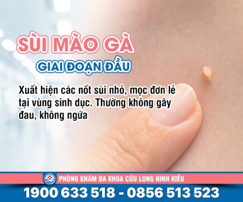 Bệnh sùi mào gà giai đoạn 1: Phát hiện sớm xử lý hiệu quả