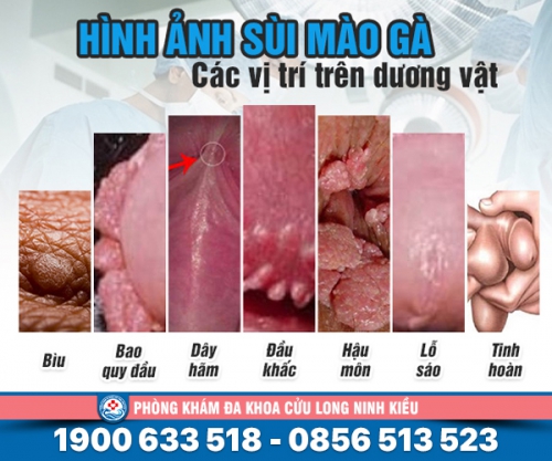 Bệnh sùi mào gà ở dương vật nam giới và những thông tin cần biết