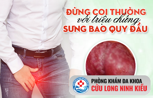 Nỗi ám ảnh mang tên sưng bao quy đầu ở phái mạnh