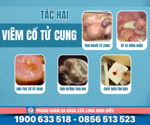 Giải đáp:Viêm cổ tử cung có ảnh hưởng gì không?