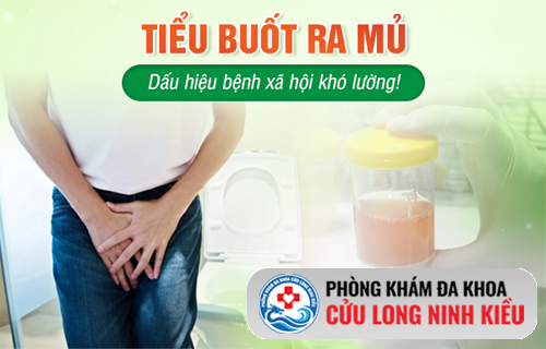 Giải mã hiện tượng tiểu buốt ra mủ – Căn nguyên và lộ trình điều trị