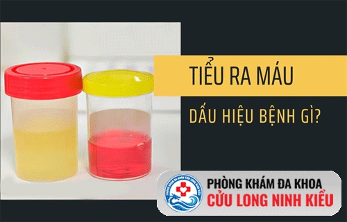 Vì sao nam giới bị tiểu ra máu? Những nguyên nhân phổ biến không nên bỏ qua