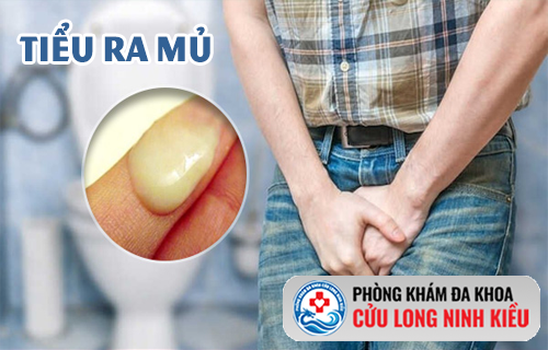 Tiểu ra mủ – Dấu hiệu cảnh báo đỏ bạn không được lờ đi