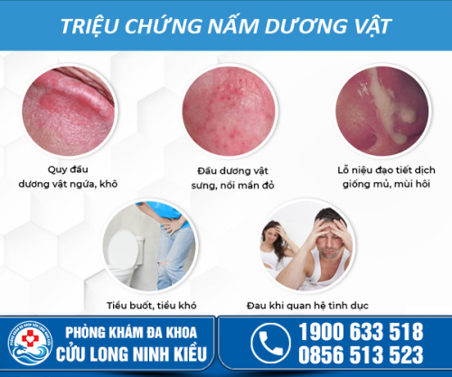 Nhận biết biểu hiện nấm dương vật giúp nam giới kịp thời thăm khám