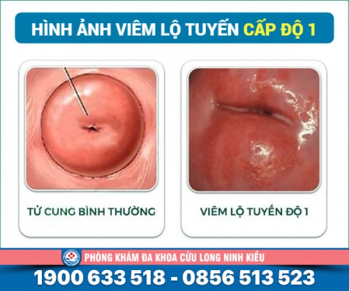 Tìm hiểu: Viêm lộ tuyến cấp độ 1