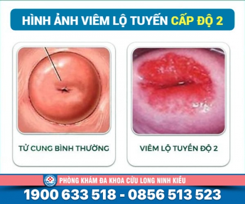 Viêm lộ tuyến cấp độ 2 và cách khắc phục hiệu quả