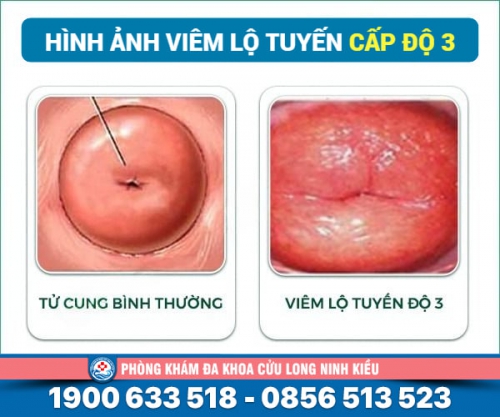 Tìm hiểu về Viêm lộ tuyến cấp độ 3